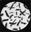 Diptheria